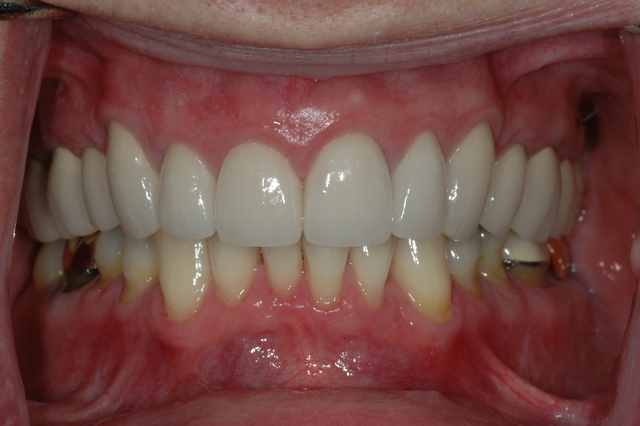 CASE 1 -AFTER with CERAMIC VENEERS