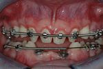 BEFORE -The Orthodontist aligns the small and missing teeth
