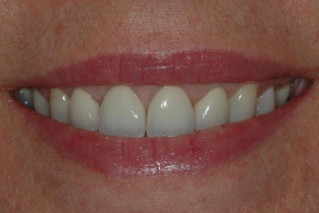 AFTER -Final veneers after orthodontic and periodontic treatment