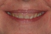 BEFORE -Pretreatment smile with abundant gingival display and dark, short teeth