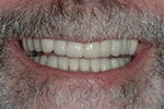 AFTER -Final full mouth crowns with restored smile 