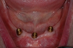 BEFORE - 3 Lower Implants (LOCATORS) - Ottawa Prosthodontist