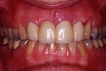 BEFORE - Older discoloured Crowns - Prosthodontics on Chamberlain 
