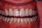 AFTER - New Upper Crowns and Lower Veneers - Prosthodontics on Chamberlain 
