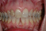 BEFORE -Upper Teeth Restored - Ceramic Veneers - Prosthodontics on Chamberlain - Ottawa Implants