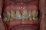BEFORE - Unesthetic upper Teeth - Ceramic Veneers - Prosthodontics on Chamberlain - Ottawa Implants