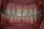 BEFORE - Aged Upper Veneers - Ceramic Veneers - Prosthodontics on Chamberlain - Ottawa Implants