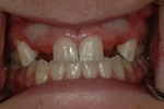 BEFORE - Missing upper teeth - Prosthodontics on Chamberlain 