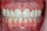 AFTER - Upper Spaces Restored with Bridges - Prosthodontics on Chamberlain 