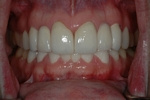 AFTER - Final Upper Ceramic Bridges - Prosthodontics on Chamberlain 
