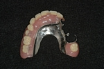AFTER - Upper LOCATOR Cast Partial Denture - Prosthodontics on Chamberlain 