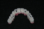 AFTER - Metal-ceramic bridge ready to be placed - Prosthodontics on Chamberlain 