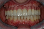 AFTER- The final bridge attached to 6 upper implants - Prosthodontics on Chamberlain 