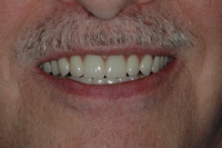 AFTER -Full Denture following removal of all teeth -Prosthodontics on Chamberlain, Ottawa