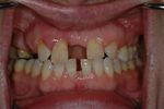 BEFORE -Several missing teeth with a large midline diastema