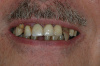 CASE 2 - BEFORE IMAGE - Failing upper/lower teeth 