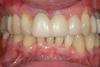 Case 2 - BEFORE - Failing Upper Teeth