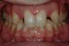 CASE 1 -BEFORE with missing lateral incisors