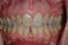 CASE 1 -BEFORE -Discoloured teeth