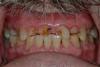 Case 1 - BEFORE - Heavy wear on upper teeth 